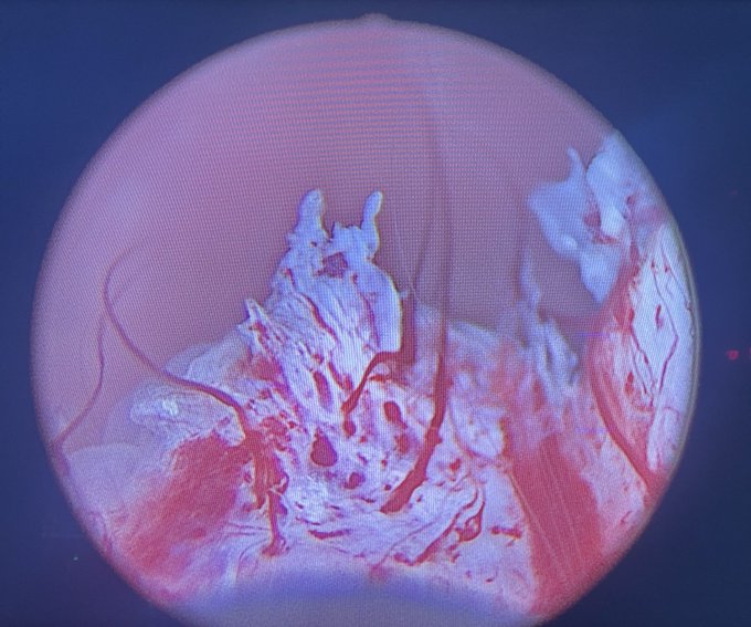 NM_Urology's tweet image. From the desk of Perry Xu, MD (@perryjxu):
-Dr. Xu is seeing more patients post-aquablation with persistent gross hematuria and LUTS. 
-Here are some endoscopic images post-aquablation (6 months to a year ago). Most impressively, one patient had fused vessels across the aqua…