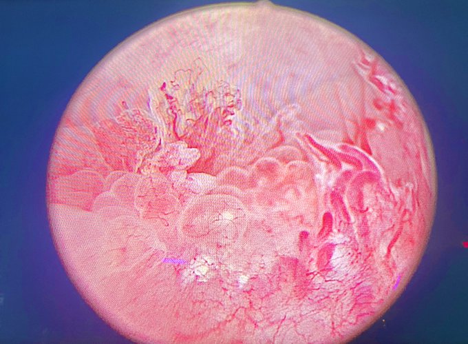 NM_Urology's tweet image. From the desk of Perry Xu, MD (@perryjxu):
-Dr. Xu is seeing more patients post-aquablation with persistent gross hematuria and LUTS. 
-Here are some endoscopic images post-aquablation (6 months to a year ago). Most impressively, one patient had fused vessels across the aqua…