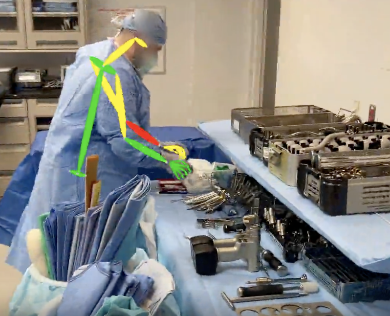 SurgErgonomics's tweet image. 📊 OR nurses are hurting—and the data are clear.

A systematic review of ~3,600 perioperative nurses found very high rates of work-related MSK symptoms:

• Low back: 62%
• Knees: 47%
• Shoulders: 44%
• Neck: 39%