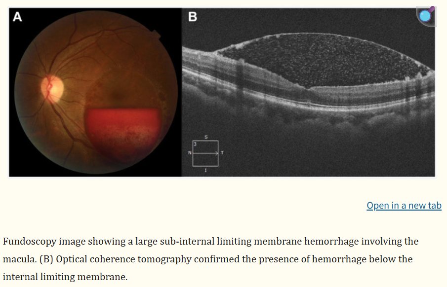Vision_Advocacy's tweet image. 🚨WARNING: LASIK can damage your retina, even in healthy eyes with no risk factors – something many LASIK surgeons downplay or deny. A new 2025 case report describes a 32-year-old woman who developed a serious bleed just under the retina's inner surface (called sub-internal…