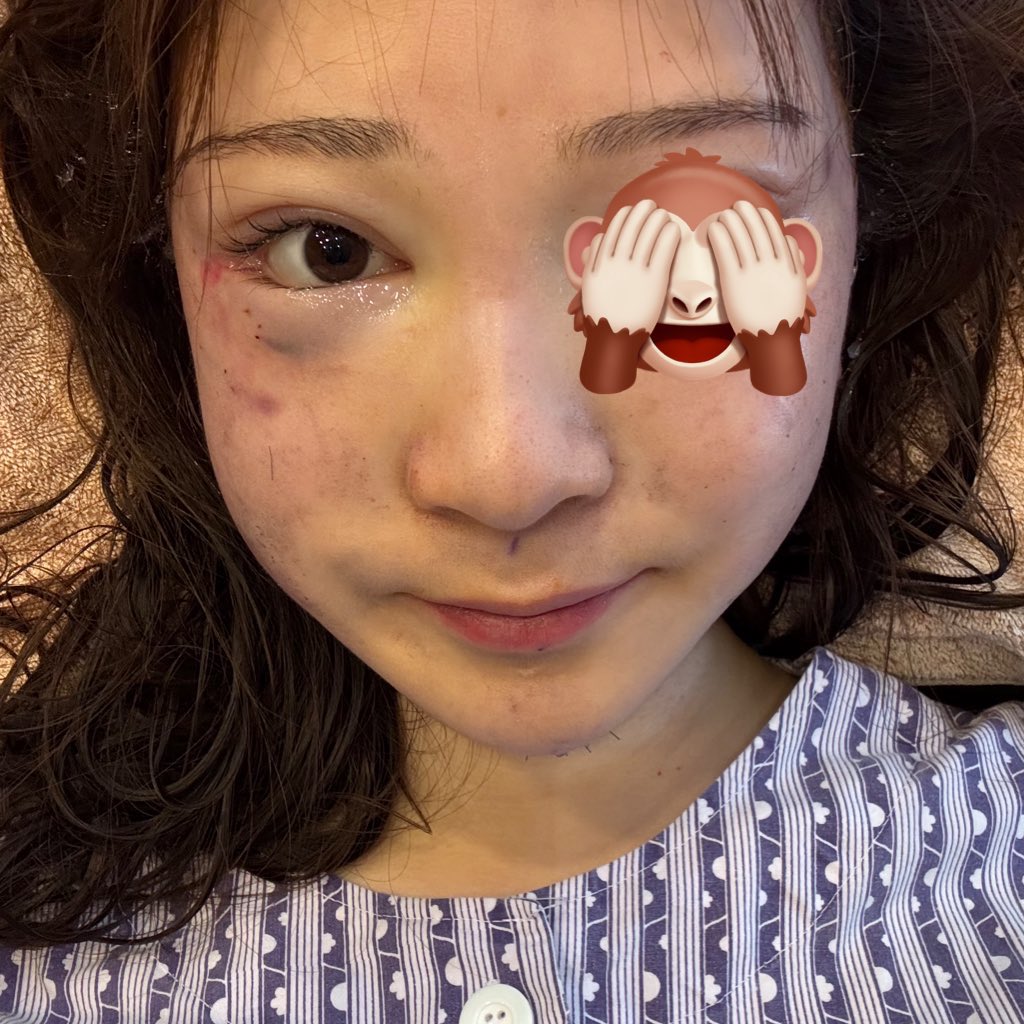 me_o089's tweet image. 両顎と切開リフトの腫れ方の違い
個人的には切開リフトのDTの方がしんどかった🥲

両顎
口開かない、喋れない、ご飯食べれない、鼻詰まってて息ができない、鈍痛(術後3日間は地獄)

切開リフト
傷口痛い、腫れがしぶとい(DT2年)、傷跡残る、マスクできない
#両顎 #切開リフト