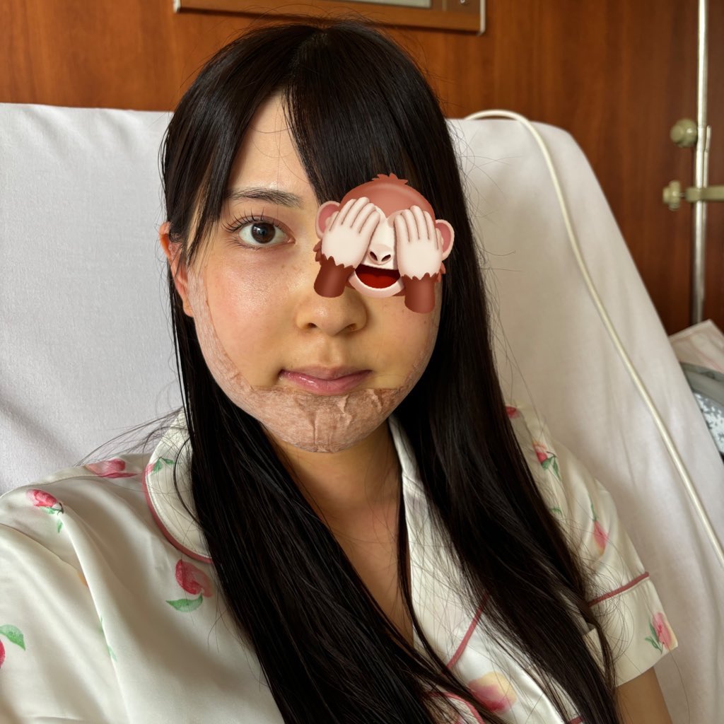 me_o089's tweet image. 両顎と切開リフトの腫れ方の違い
個人的には切開リフトのDTの方がしんどかった🥲

両顎
口開かない、喋れない、ご飯食べれない、鼻詰まってて息ができない、鈍痛(術後3日間は地獄)

切開リフト
傷口痛い、腫れがしぶとい(DT2年)、傷跡残る、マスクできない
#両顎 #切開リフト