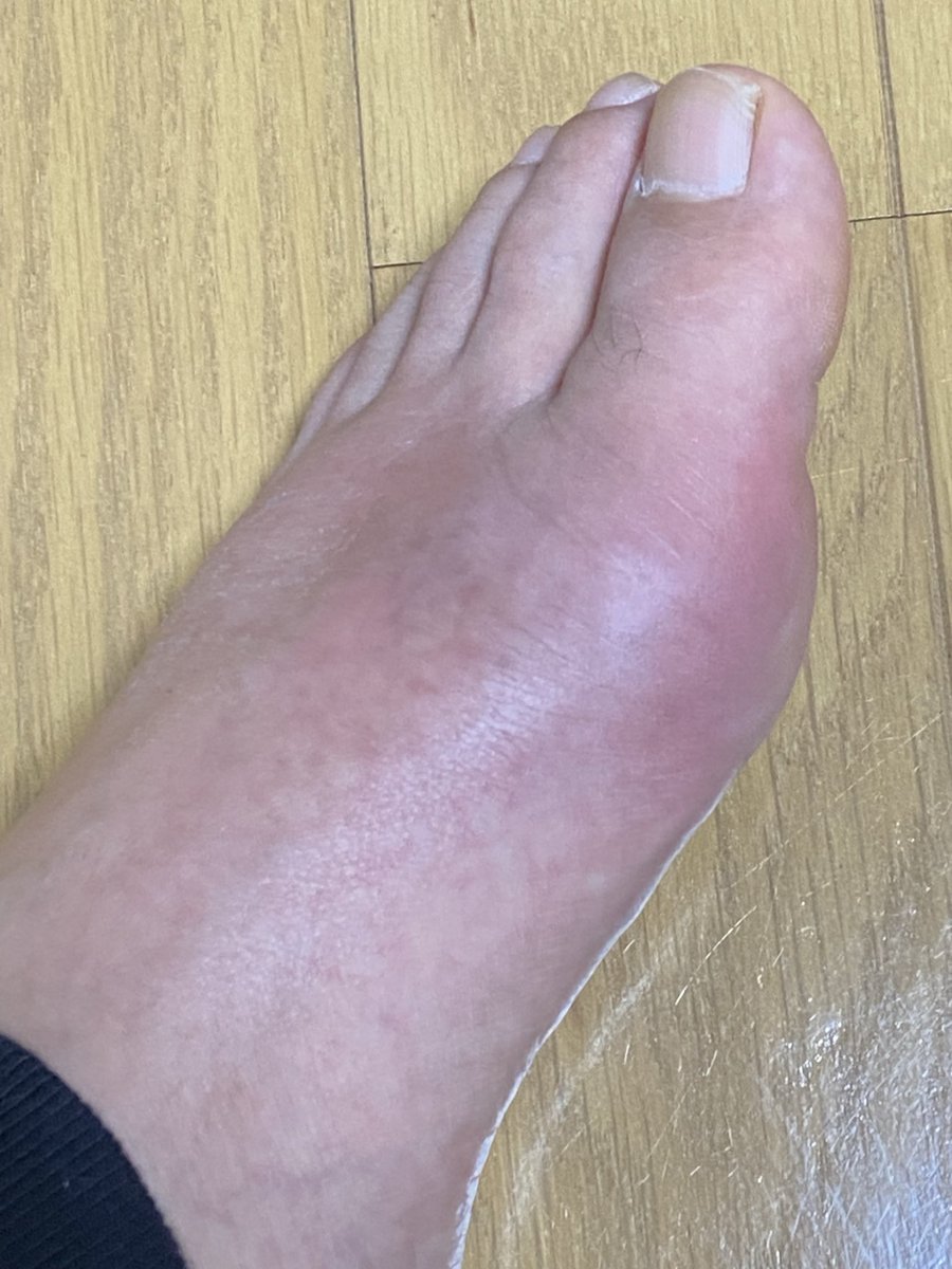 ShibukiTaki's tweet photo. 28日から痛風発作の洗礼
⛰️はお預け https://t.co/jyvgPrYH4x