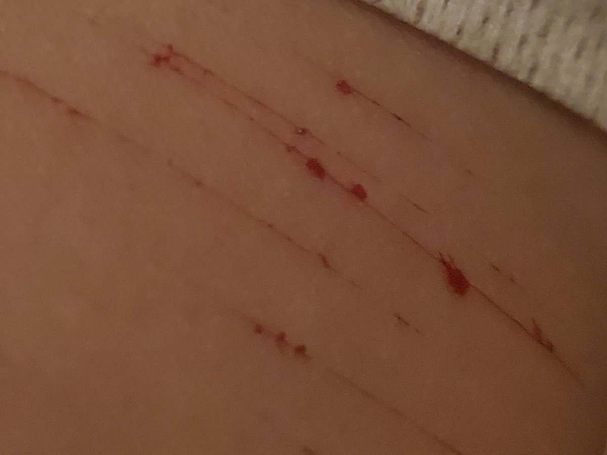 Sh0tGunManz's tweet photo. First time making it bleed like that, wouldn't go deep because I still need this arm. Wonder what type of cuts this is supposed to be because I am unsure
#shtwt #shtt https://t.co/ueDY8NaMDL