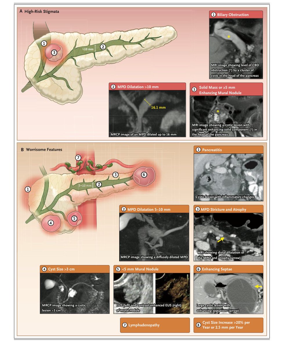 AchintyaSinghMD's tweet image. Excellent illustrations, review of pancreas cysts: nejm.org/doi/full/10.10…
➡️ 15% panc cancer arise from cysts
➡️ EUS&amp;gt;MRI: connection with ducts, ampulla evaluation, mural nodules 
➡️VHL: Serous, MEN: NET, KRAS or GNAS: IPMN, GTNNB1: SPNT
➡️Minimal surgical excision is an option!