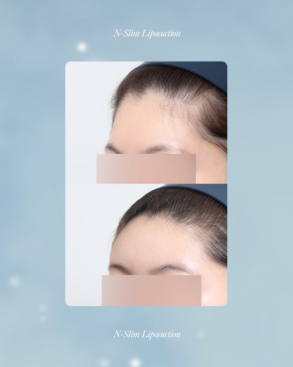 額脂肪注入で若返り＋立体感アップ❤️
ビフォーアフターをチェック✨

☘️お問い合わせ
(日本語対応可能)
📲82-10-6771-4500
LINE ID : @nslim

💓日本語通訳が常駐しています🥰
診療時間内に対応します。

☘️診療時間案内
火曜日~金曜日 10時~19時
土曜日 9時~16時
毎週日曜日、月曜日、祝日休診