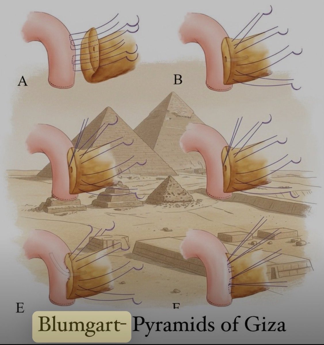 SCatuta's tweet photo. Dr. SANTIAGO CATUTA: CIRUGIA DE WHIPPLE .- Inicio anastomosis pancreático-yeyunal (PJ) pos pancreaticoduodenectomía cefálica. Quito 2025 https://t.co/nBg3Wl0jpQ