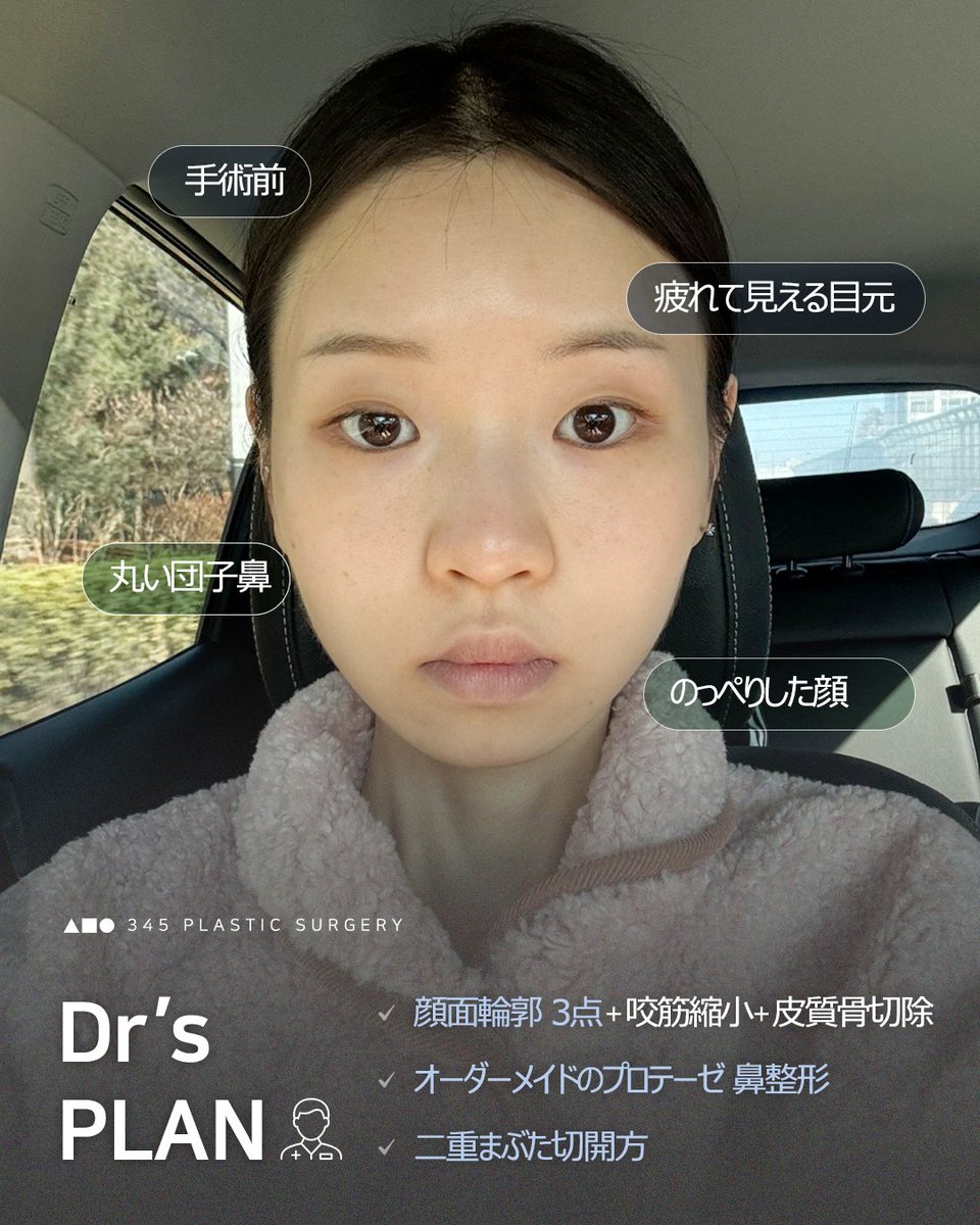 輪郭3点＋鼻整形＋目整形 トータルフェイスデザインでここまで変わる。 手術前は ✓ のっぺりした顔立ち ✓ 丸い団子鼻 ✓ 疲れて見えやすい目元  輪郭・目・鼻をバランスよく整えることで、 自然なたまご型フェイスへ。 「雰囲気が変わった」 「アイドルみたいって言 ..., image size:960x1200