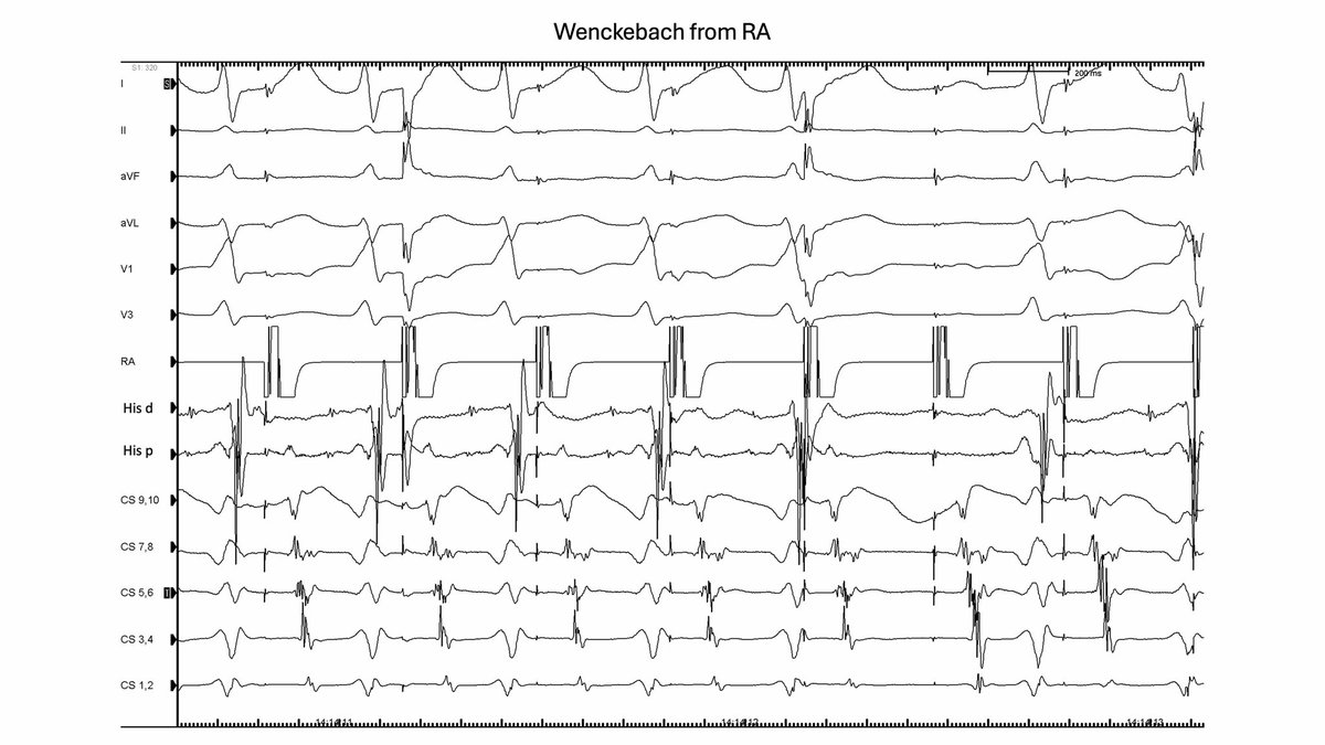 Luis Quininir, MD ECES FACC 🇨🇱 tweet media