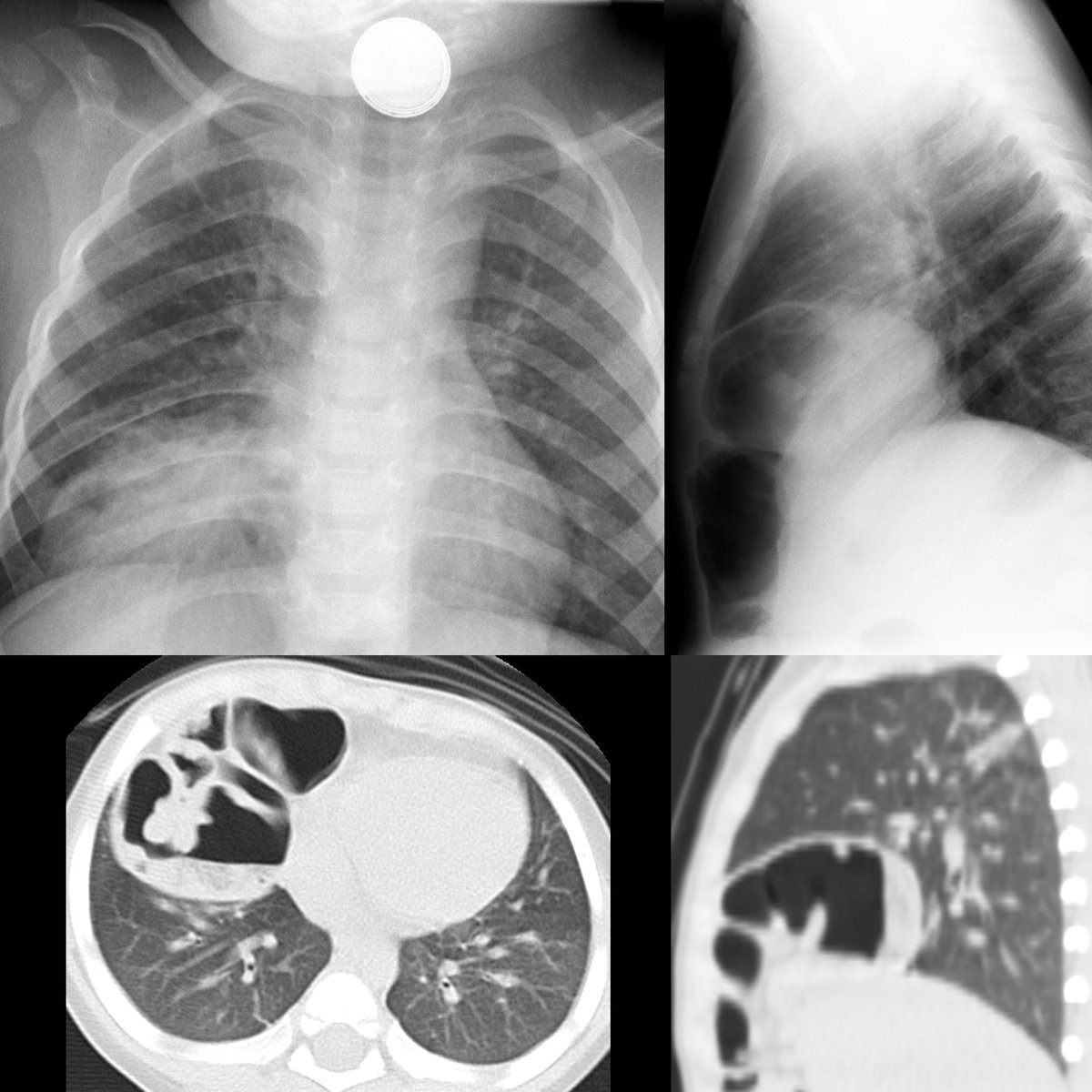 pedsimaging's tweet photo. Toddler who is choking on something

CXR AP(above left) shows round radiopaque object with halo of lucency around it in neck+there is dense opacity in medial aspect of right lower lobe

#FOAMRad #PedsRad #RadEd #radiology #pediatrics #radiologia #EmergencyMedicine #paediatrics https://t.co/PCO2hRgFoa
