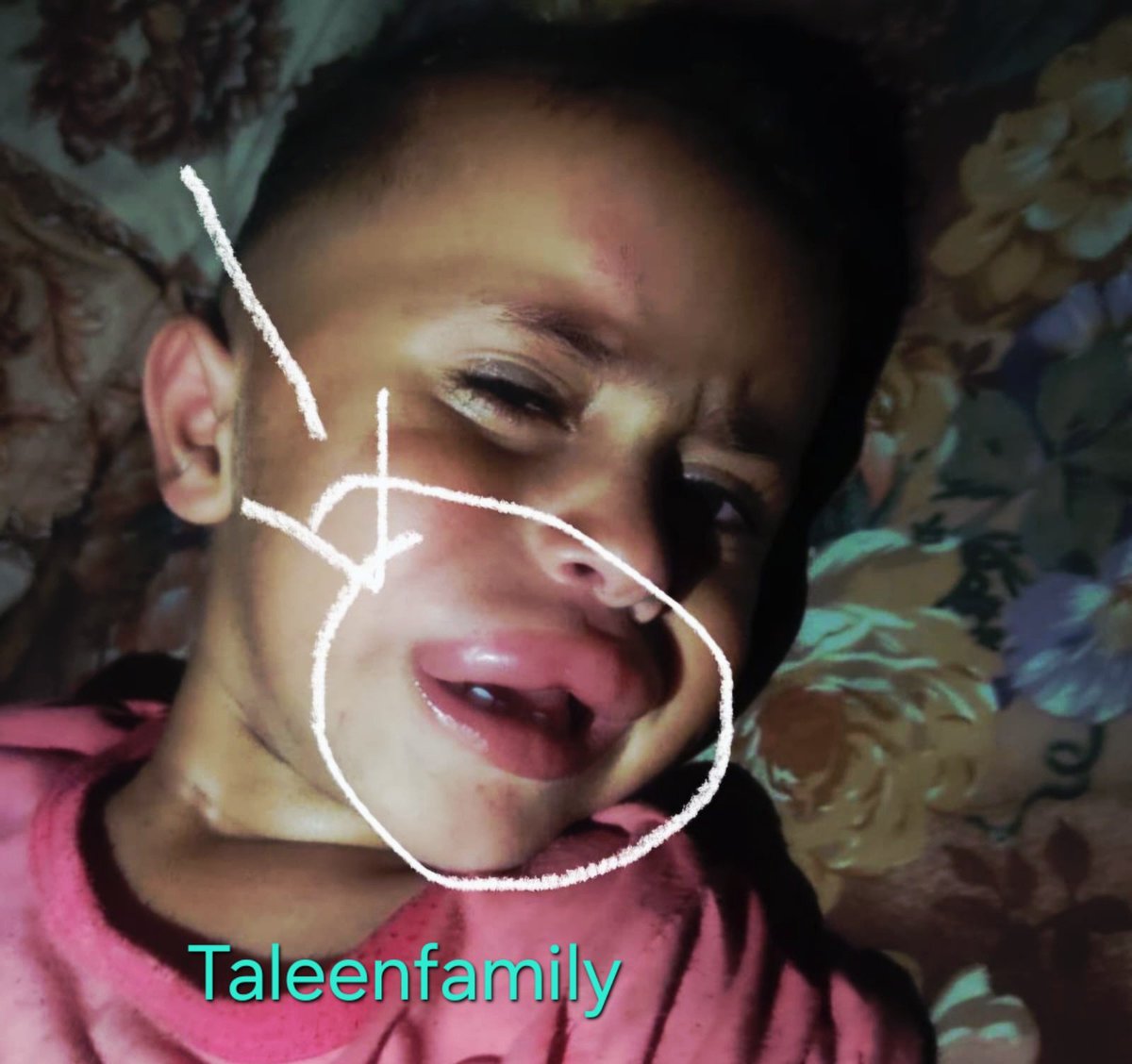 TaleenFamily's tweet image. My little son suffers from crazy pain, he suffers from a "Rat bite" due to lack of shelter and cleanliness, we sit in a shelter full of flies, insects and garbage, our house is completely destroyed

3 replies - even dots — can save my children

chuffed.org/project/taleen