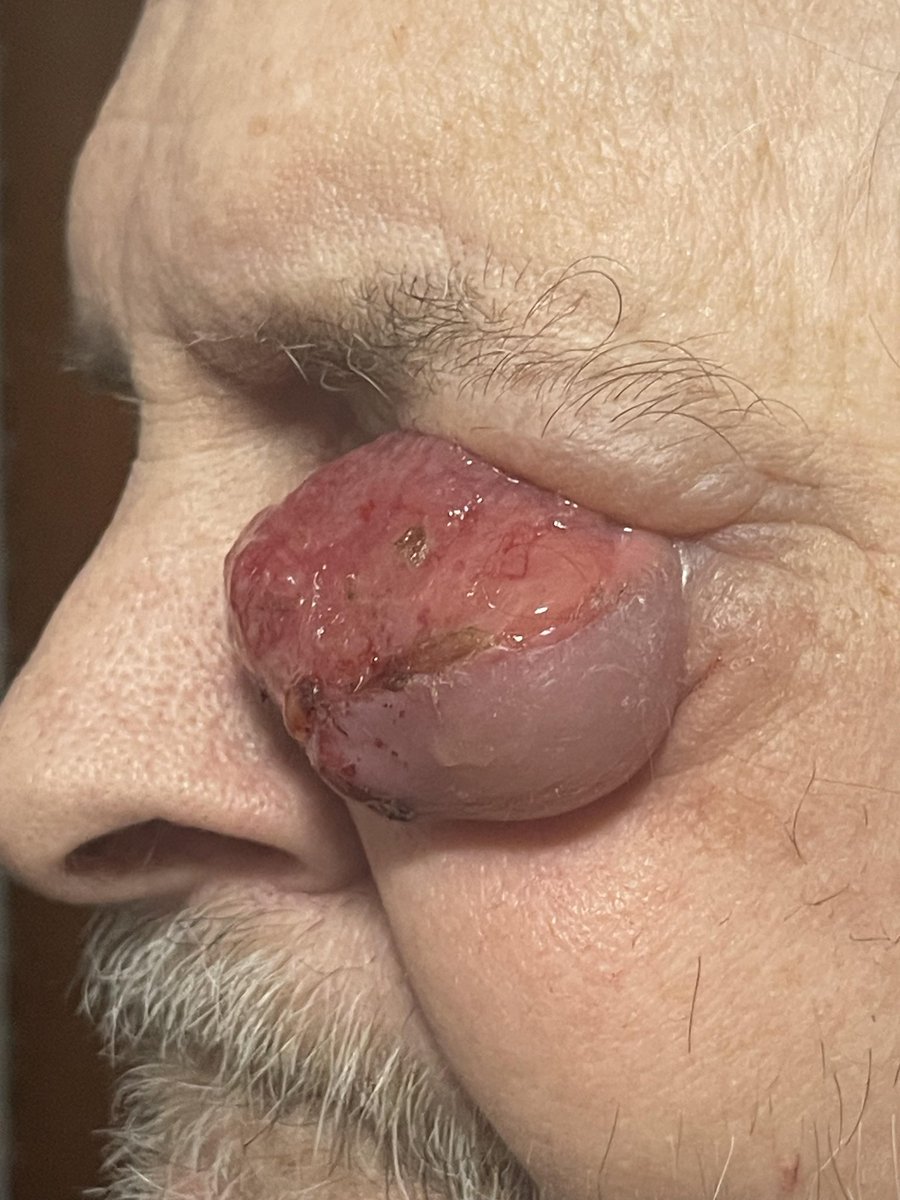 codmantriangle's tweet photo. Invasive Squamous Cell Carcinoma
#Cancer https://t.co/qTYU9fbshB