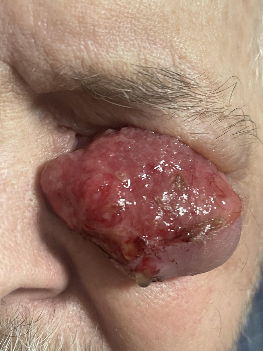 codmantriangle's tweet photo. Invasive Squamous Cell Carcinoma
#Cancer https://t.co/qTYU9fbshB