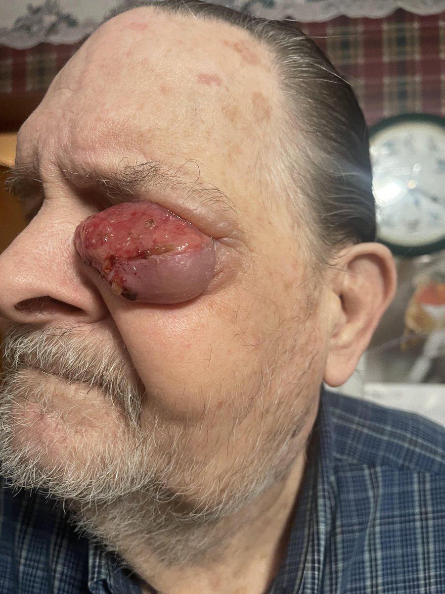 codmantriangle's tweet photo. Invasive Squamous Cell Carcinoma
#Cancer https://t.co/qTYU9fbshB