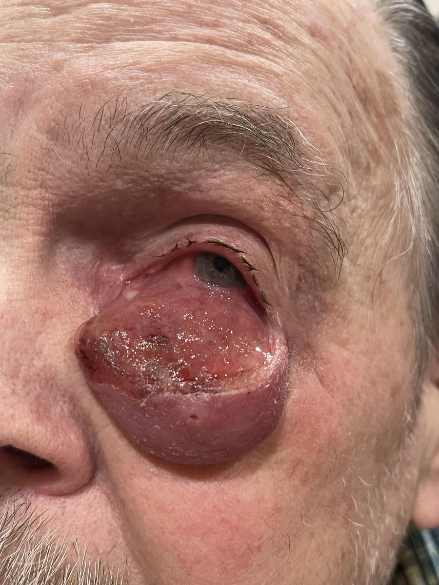 codmantriangle's tweet photo. Invasive Squamous Cell Carcinoma
#Cancer https://t.co/qTYU9fbshB