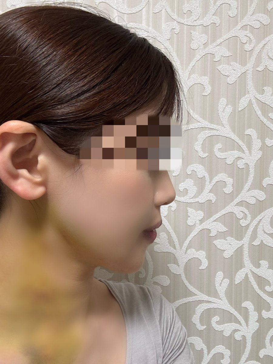 baebaee_____'s tweet photo. DT1週間
熱感は取れたので、最近はあざを取るために温パックや半身浴をするように心がけています！

コンシーラーありでようやく人前に出られる顔になったかなという印象🙂‍↕️
あまりDTが取れない方は、事前にあざ隠し用のコンシーラーを準備しておくと安心です！
@TTps_jp https://t.co/KjNUYmQS0Y