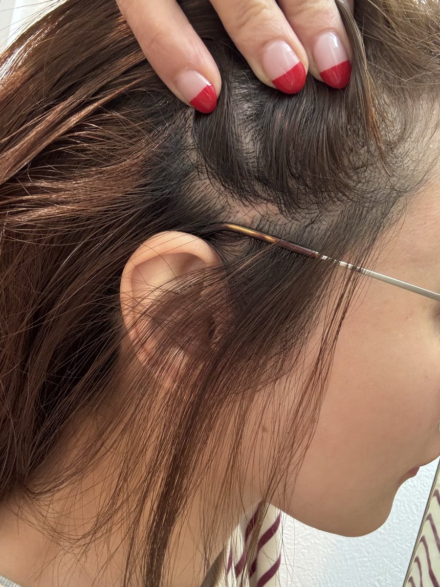 m_diess's tweet photo. 切開リフトから1年経過📍
私はもみあげを温存し頭皮の中を切るやり方でした。例えコメカミともみあげを切った方が効果に若干の差が出るとしても、私はもみあげを残す方を選びます。
多毛なので傷も掻き分けて探さないと分からないレベル🤣この辺りの傷なんて全く目立たないです。 https://t.co/OKSGamp9xJ