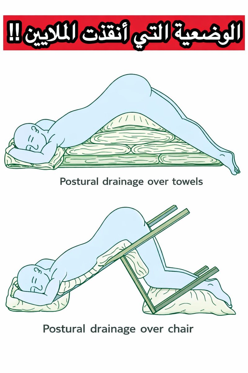 💡 عندما تتوفر الحلول في أبسط الأشياء!

قبل عقود، لم تكن هناك أجهزة تنفس متطورة أو أدوية قوية لمساعدة المرضى الذين يعانون من انسداد الشعب الهوائية. 

ومع ذلك، وجد الأطباء والممرضون طريقة بسيطة تُسمى التصريف الوضعي.

🩺 الفكرة باختصار:

وضع المريض في وضعيات معينة بحيث تساعد