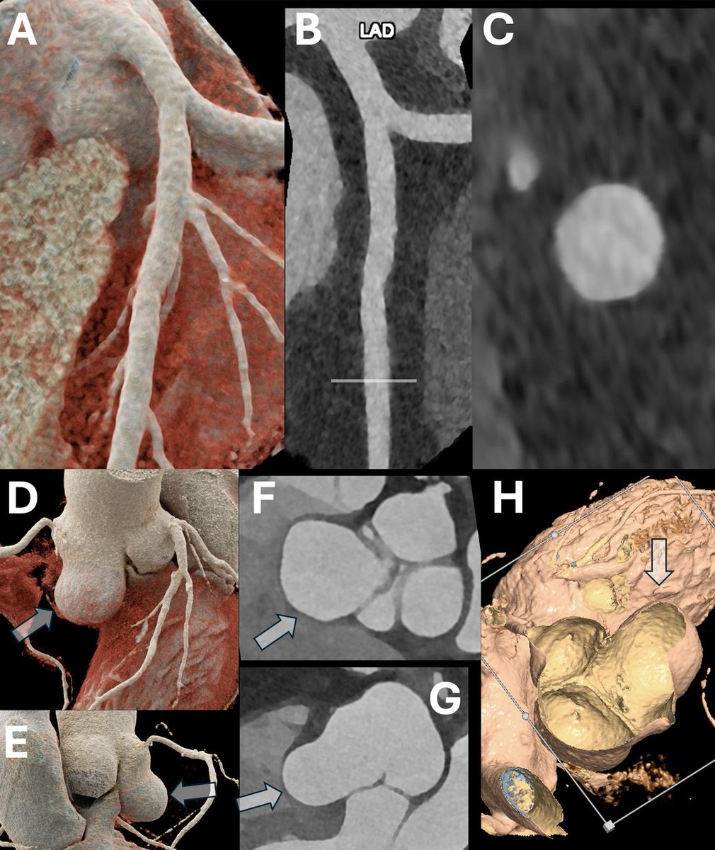 Current and future applications of photon-counting computed tomography in cardiovascular medicine

Learn more about this fascinating technique which is coming to cardiovascular medicine:

Paper: bit.ly/4r8U8W3

Podcast with the authors:
bit.ly/49oxvq9