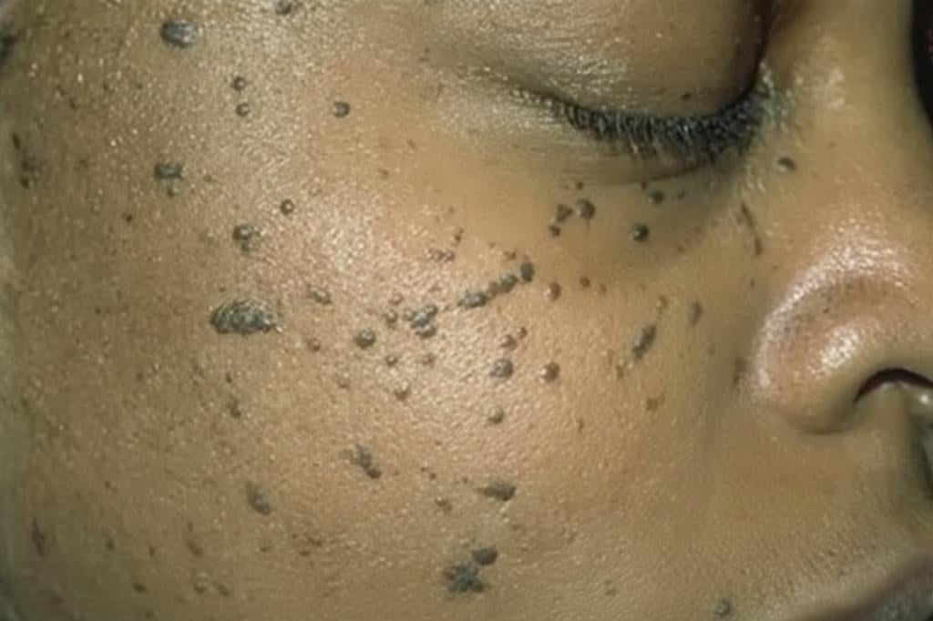 g_diets_'s tweet photo. Do you know you can get rid of skin tags by eating right?

You don’t need to rub the chemicals they cajole you into buying.

Skin tags, also known as acrochordons, can be a sign of insulin resistance. And when you eliminate sugar, wheat, and seed oils from your diet, your body can begin to correct the root cause.

You can also apply extra virgin olive oil to your skin instead of spending money on unnecessary treatments.

Fix your diet and see the difference for yourself.
If you’re ready to do it properly, reach out for a personalized diet plan, and share this with someone who needs to see it.