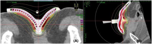 RDC13ro's tweet photo. Extramammary Paget's disease is a rare neoplasm that typically presents in the genital area.
In this series, we present an innovative approach using brachytherapy with custom-made 3D-printed molds. @DrAmanTaggar https://t.co/PxsoXnUJxx