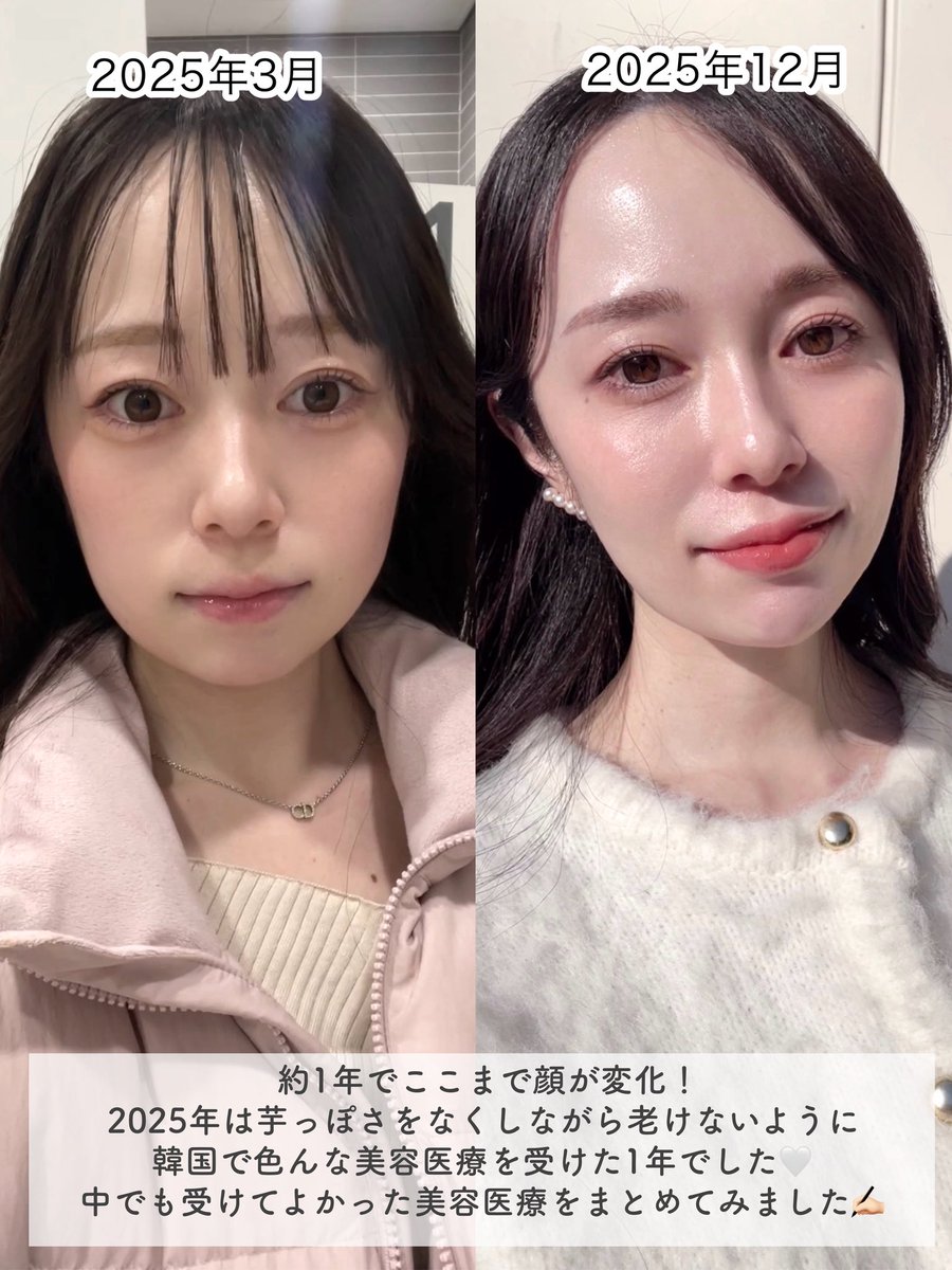 ことみ　プランエスクリニック 江南 PlanSクリニック｜江南駅・三成(COEX)(ソウル)の美容医療