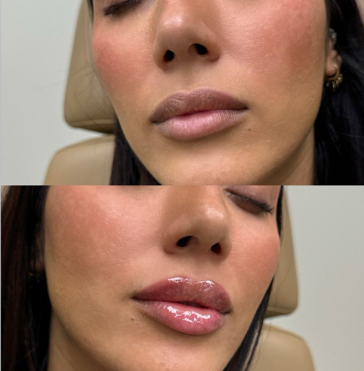 We love a natural Lip Filler 💉

Remember, good work isn’t always detectable