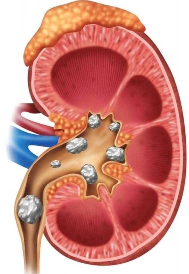 arabaltmed's tweet photo. ألم حصى الكلى لا يُحتمل.. و90% من مسبباته تبدأ من مطبخك! 🧊⚠️

إليك "الخطة الشاملة" لحماية كليتيك ومنع تكوّن الحصوات طبيعياً:

1️⃣ مشروبات الحماية:
 • الماء: المحرك الأساسي (الجفاف هو العدو الأول). 
• الليمون: يحتوي على "السترات" التي تكسر رواسب الكالسيوم.
 • الكركديه: يطرد حمض اليوريك بفعالية.
 • الريحان: غني بحمض الخليك الذي يسكن الألم ويفتت الحصى.
 • حبة البركة والحلبة: مقاتلات شرسة ضد أوكسالات الكالسيوم.

2️⃣ القاعدة الذهبية (ممنوعات): 
❌ السكر الأبيض والقمح. 
❌ الزيوت المهدرجة (استبدلها بزيت الزيتون). 
❌ التقليل من المنبهات (شاي وقهوة).

3️⃣ نمط الحياة:
 ✅ الرياضة + راحة البال = كلى سليمة.

#صحة #حصى_الكلى #توعية_صحية