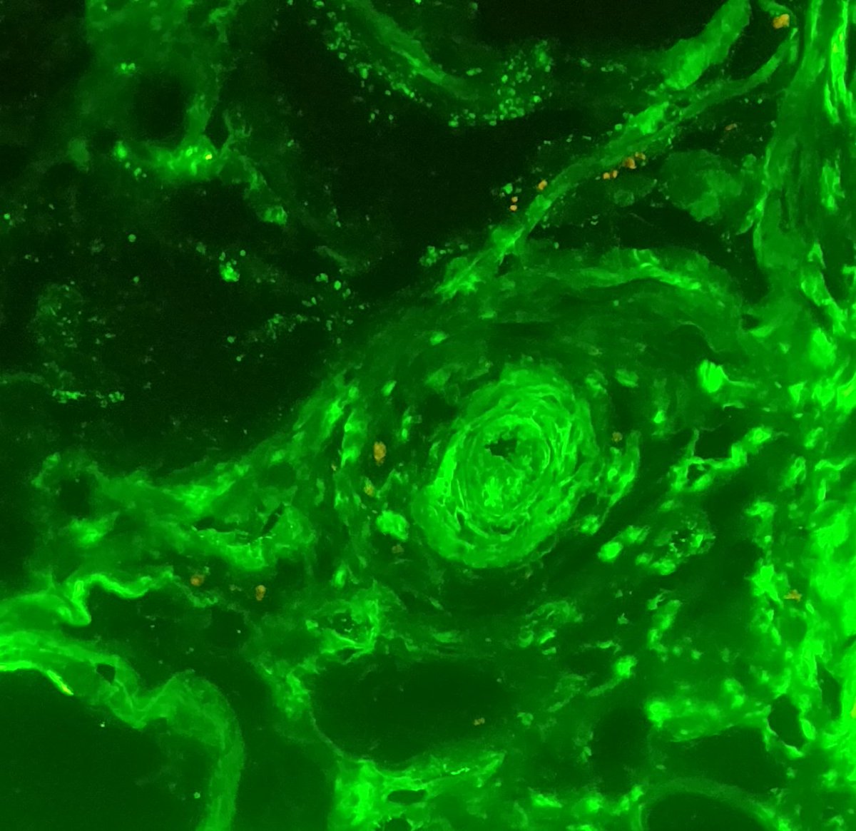 DelsanteMarco's tweet image. Last case of the year: unexpected renal TMA with arteriolar thrombi (positive on fibrinogen antisera here). Coexisting with full house glomerular deposits, likely SLEN. 
Light microscopy will be ready next year;)

#renalpath #askrenal #kidneybiopsy