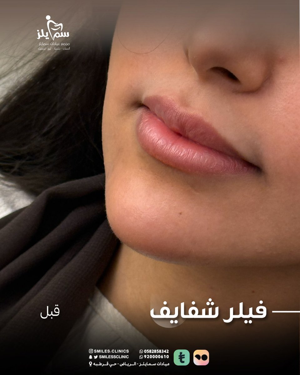 فيلر شفايف + دقن د منى الفرماوي