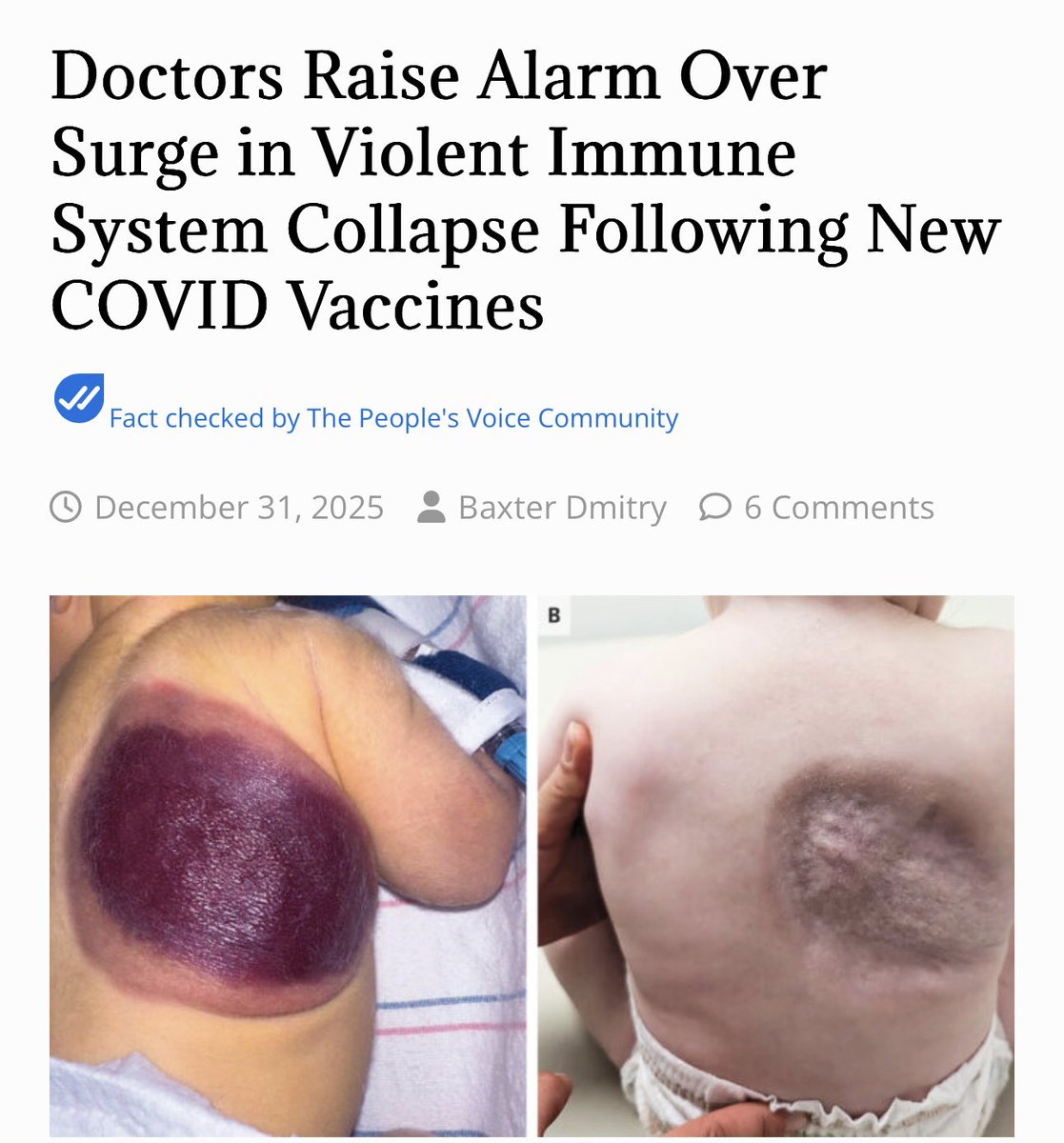 toobaffled's tweet image. A previously rare, violent immune disorder is skyrocketing in clinical settings just as new COVID vaccines are administered—and public health authorities appear determined to look the other way.

The condition, known as TAFRO syndrome, unleashes a catastrophic inflammatory…