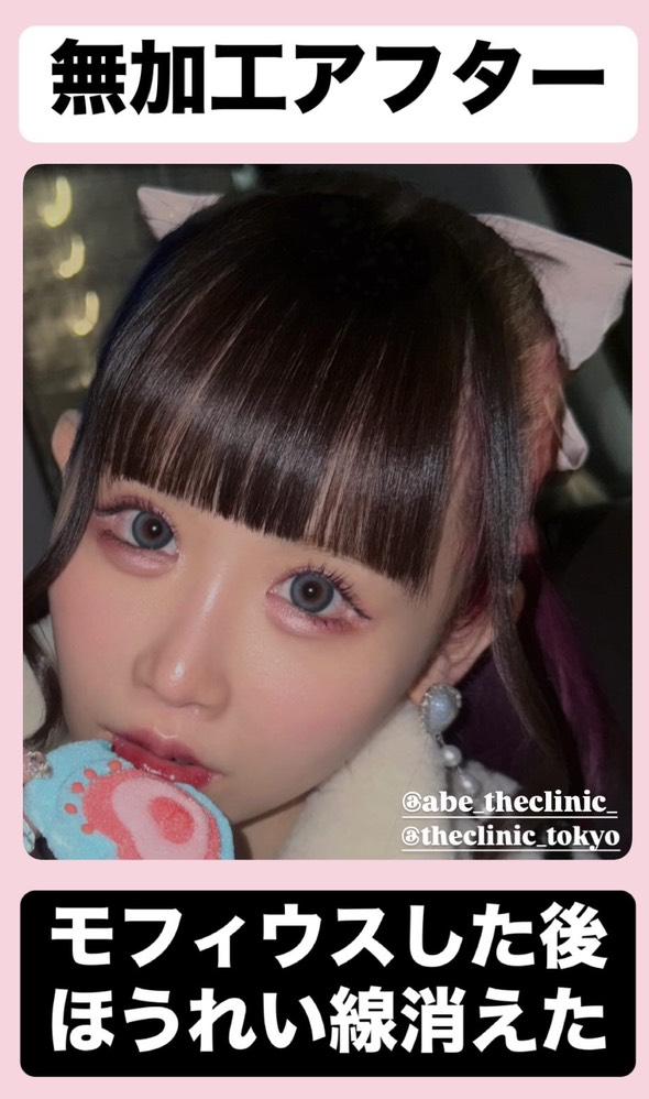 第56回モフィウス プレゼント💐
新年最初のお年玉運試し🎯
ザクリニックはゆりにゃさんと「リアルドール」ブランドを立ち上げました✨️
ゆりにゃさんやPretty Chuuみたいなリアルドールになりたい方へ💃
「目の下」「ほうれい線」「口横のポニョ」を3名様に無料プレゼント🙆