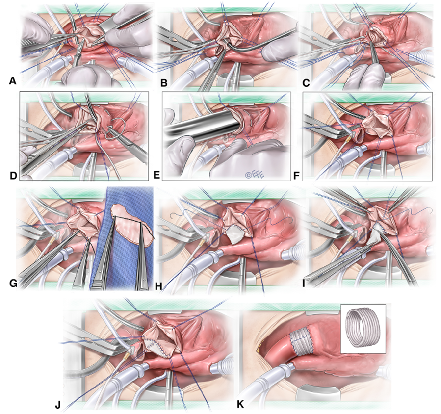 konstantinov_ie's tweet photo. TRUNCAL VALVE REPAIR IN OLDER CHILDREN AND ADULTS https://t.co/zfLDrZqRy7