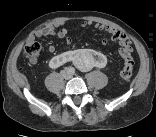 radiology2022's tweet photo. 馬蹄腎（Horseshoe kidney）

✅400-500人に1人で男性に多い（2:1)
✅合併症：水腎症、尿路結石、嚢胞性腎盂尿管炎、外傷しやすい、癌になりやすい、高血圧
✅関連：ダウン症、ターナー症候群など染色体異数性疾患とVACTERL associationなども非異数性疾患 https://t.co/Vh0huMJiOq