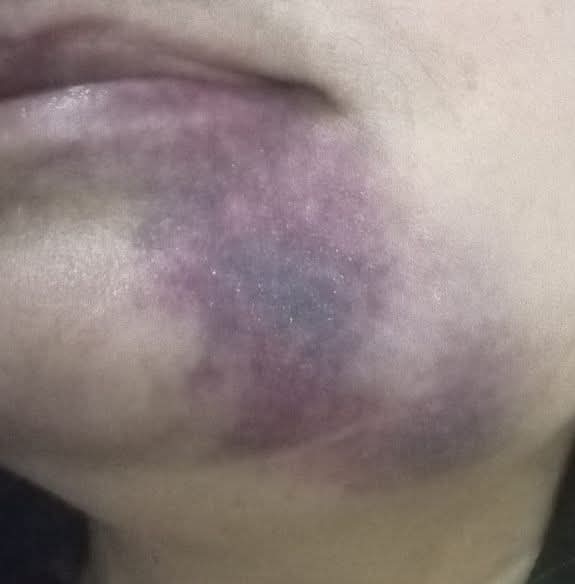 Annemin dişi çekildi böyle morardı dişçi normal diyor başına gelen var mı normal mi bu??