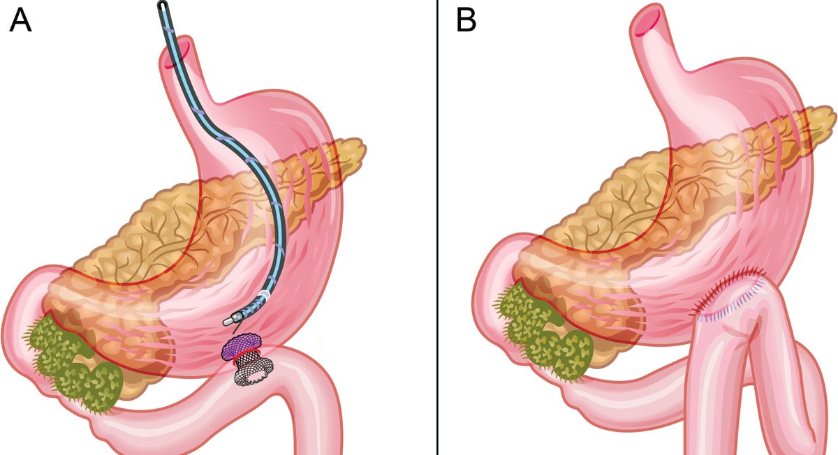 Gut_BMJ's tweet image. #GUTImage from the paper by Bang et al on 

"Endoscopic or surgical gastroenterostomy for malignant gastric outlet obstruction: a randomised trial" via

bit.ly/44ldMV6

#Endoscopy #GastricOutletObstruction