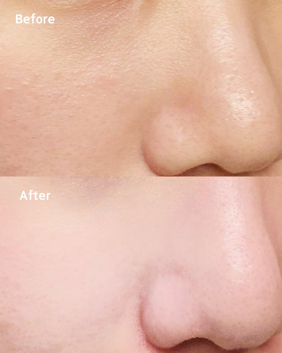 #광고 #Rt_이벤트 @hanyulofficial
#Rt 하신 총 5분께 선물 드림!
당첨자 발표는 1/9(금)!!

1등: 올리브영 3만원권 (1인)
2등: 스타벅스 2만원권 (1인)
3등: 한율 쑥떡팩폼 기획세트 1ea (3인)

피지 고민 이제 그만!
피지 잘 가게!!!
ㄴ 한율 쑥떡팩폼만 있으면 가능

우둘투둘한 피지들이 정리된 거