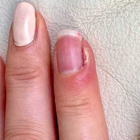 QwinOj's tweet photo. Canker sore in your mouth or whitlow on your finger- which hurts worse? Be honest, I've had both and I'm still traumatized.😩 https://t.co/KgnH47rZpp