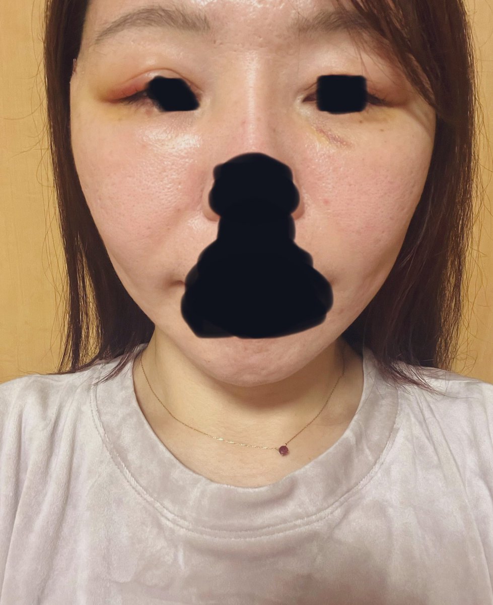切開リフトDT3日目の傷跡の様子です◎
内出血と目元に腫れが出てきましたが傷跡の経過は良好です✨
フェイスラインもばっちり綺麗です！！
#切開リフト
#石倉クリニック