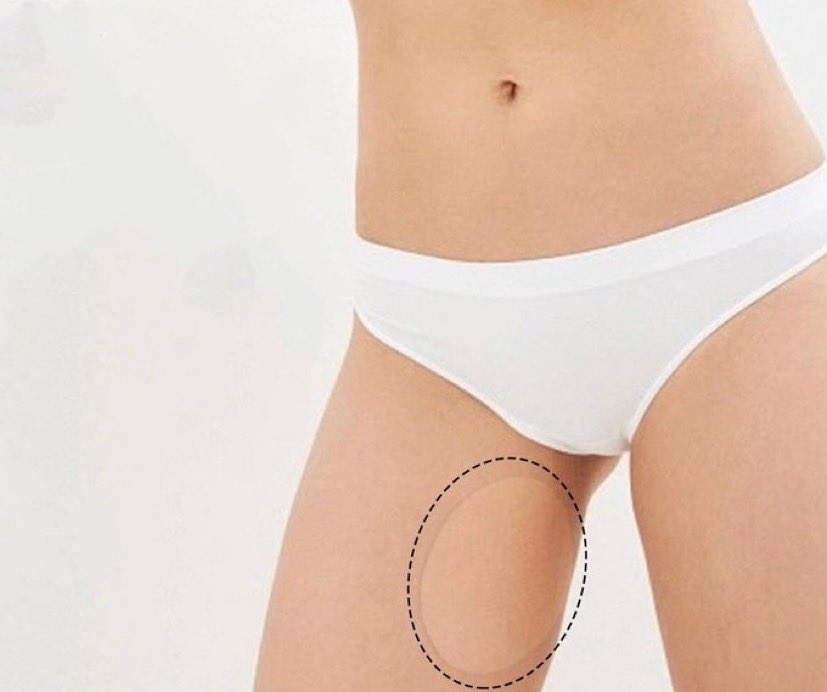 psmark1821's tweet image. มึงคือกูอะอ้วนขึ้นมาก ละเดินละมันขาเบียดอะมึง 55555 ละกูไปเจอแผ่นปะลดการเสียดสีตรงขา กูเลยสอยมา วันเวิคมากมึง นวัตกรรม‼️