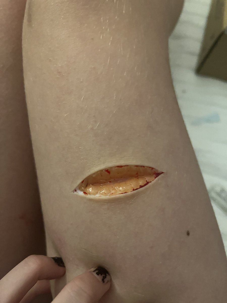 _ketamxne's tweet photo. fresh vs healed fascia
ALL FAKE ALL SFX
#shtwt #slittwt #styrotwt #beanstwt #fasciatwt #988twt #shedtwt https://t.co/tPbmb28xpf