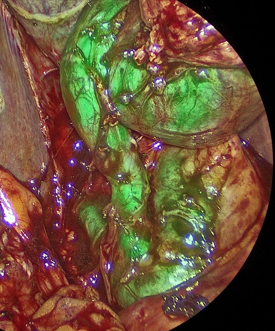 SArshiaArshad's tweet image. Identify this interesting biliary anatomy variant seen during a laparoscopic cholecystectomy #gallbladder #SoMe4Surgery @SAGES_Updates @EzraTeitelbaum @EdLinEmory @EricKnauerMD @MBosleyMD @GAHerniaSurgeon @drkeithsiau @rbarbosa91