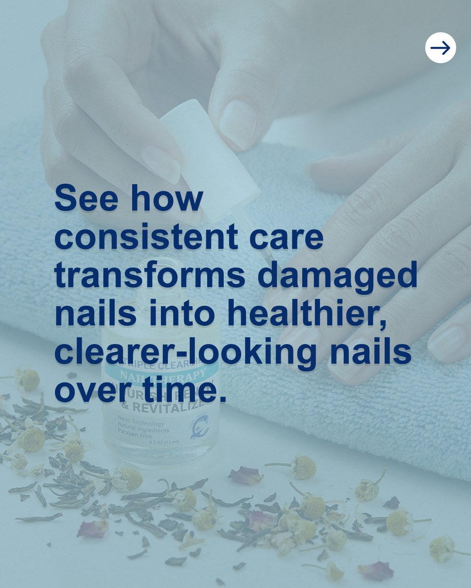 TripleClearHF's tweet image. Brittle, discolored, or weak nails can transform with consistent care.

Triple Clear HF treats and protects nails, helping them become stronger, smoother, and healthier-looking.

Begin your nail journey today: TripleClearHF.com

#NailTransformation #TripleClearHF