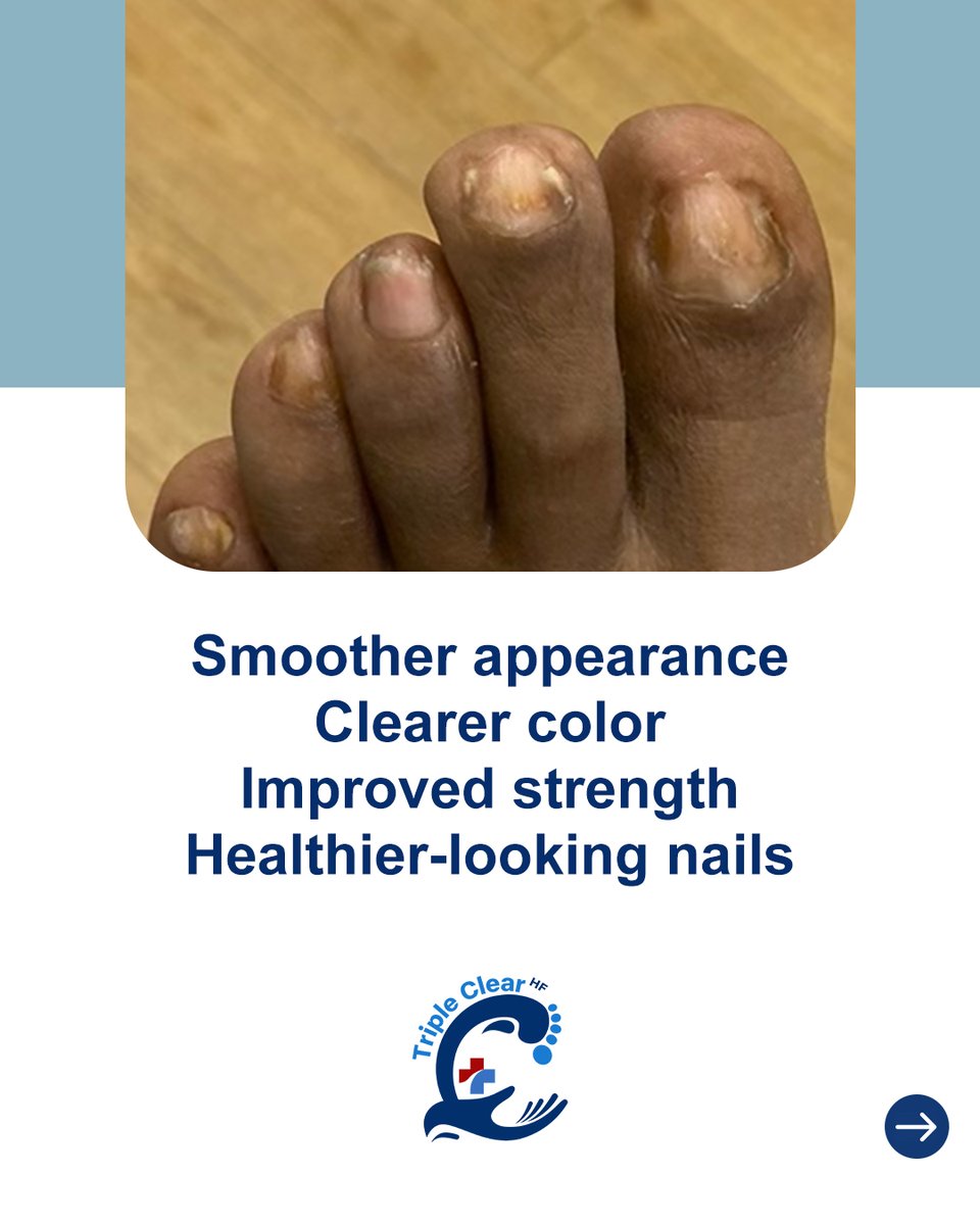 TripleClearHF's tweet image. Brittle, discolored, or weak nails can transform with consistent care.

Triple Clear HF treats and protects nails, helping them become stronger, smoother, and healthier-looking.

Begin your nail journey today: TripleClearHF.com

#NailTransformation #TripleClearHF
