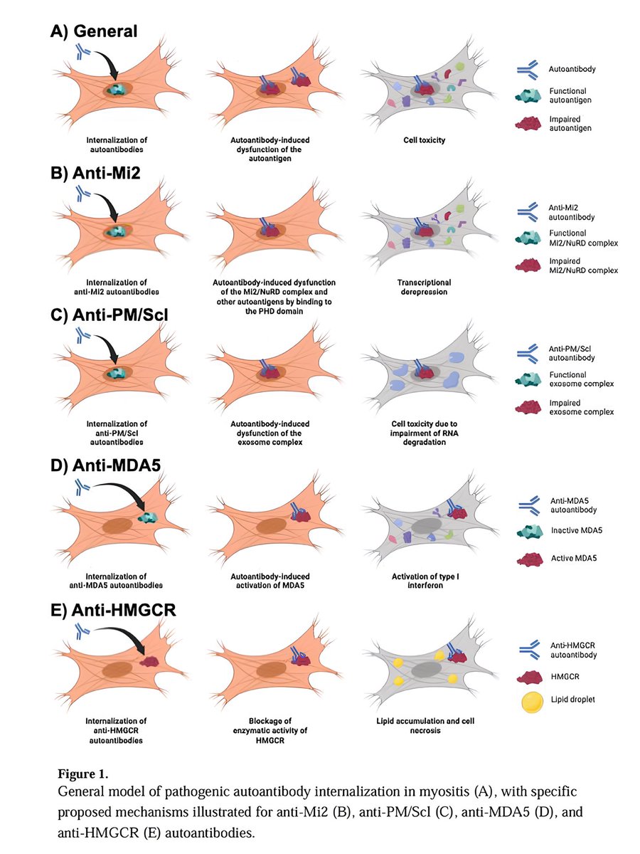 alb_giraldo's tweet photo. Emerging evidence supports a novel model in #myositis where #autoantibodies (particularly anti-Mi2, anti-MDA5, anti-HMGCR, and anti-PM/Scl) enter live skeletal #muscle cells, disrupt target antigen function, and cause damage—distinct from traditional type II/III hypersensitivity. Patient-derived autoantibodies induce transcriptomic and histopathological changes in cultured myoblasts that mimic patient biopsies, though evidence is lacking for anti-NXP2 and anti-TIF1γ groups, and in vivo internalization mechanisms remain unknown.

Future research should examine effects on other muscle-resident cells (e.g., endothelial, fibroblasts, immune cells), test in vivo models, and investigate entry mechanisms (e.g., Fc receptor dependence).

Implications for idiopathic inflammatory #myopathies:
• Supports quantitative and potential functional autoantibody assays for diagnosis, prognosis, and therapy monitoring.
• Suggests B cell/immunoglobulin depletion as effective for muscle involvement.
• Indicates therapies restoring target antigen function may be beneficial.

This internalization model may extend to other #autoimmune diseases with autoantibodies targeting intracellular antigens (e.g., certain neurologic disorders, systemic sclerosis, SLE, ANCA-associated vasculitis), warranting further cell-based and in vivo studies.

*From: Kirou RA, Pinal-Fernandez I, Mammen AL. Autoantibody internalization in myositis skeletal muscle: Emerging evidence, mechanistic insights, and therapeutic relevance. Autoimmun Rev. 2025 Nov 25:103962. 
🔗https://t.co/lX8HsFfIi5