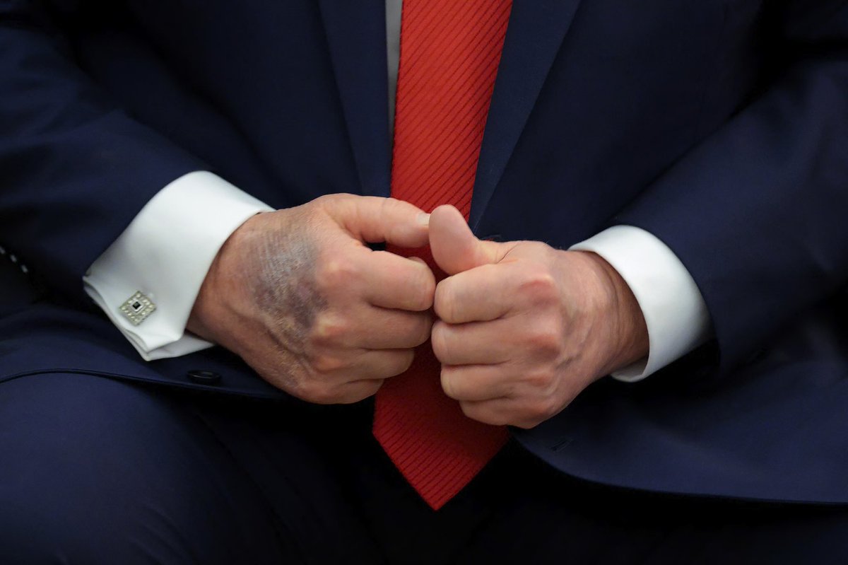 AFpost's tweet image. President Trump revealed that his hands are bruising because he’s taking high doses of aspirin to “prevent thick blood” from pouring through his heart.

Follow: @AFpost