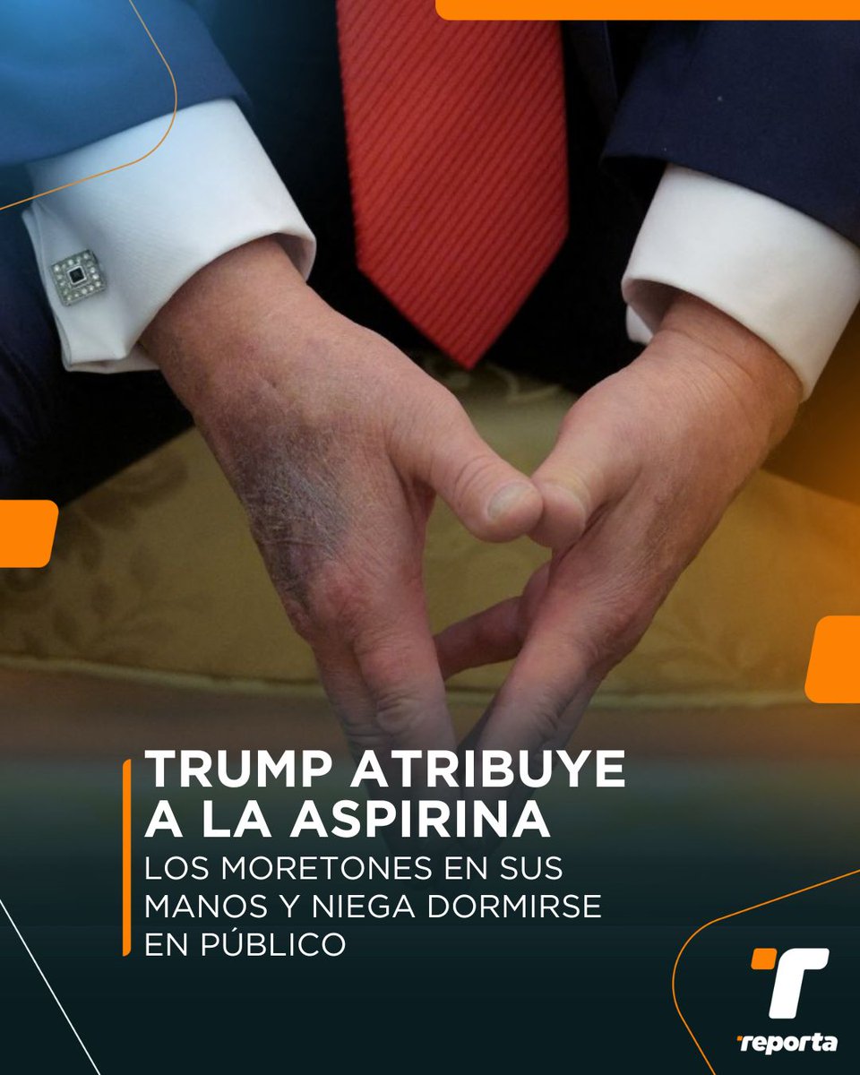El presidente de Estados Unidos, Donald Trump, culpó a la aspirina por los  grandes moretones que presenta en su mano y negó haberse quedado dormido  durante reuniones públicas, en una entrevista con, image size:960x1200