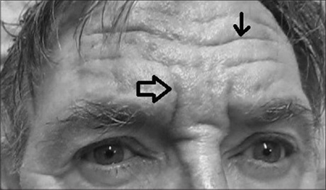 What is this sign?

Has history of frequent falls.

Image from - DOI: 10.4103/aian.AIAN_408_17