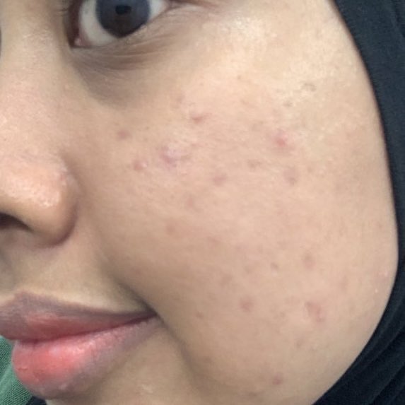 lippppeye's tweet image. KATA GW SIH.. KALO PUNYA DUIT TREATMENT‼️

✨ ACNE DARK SPOT PICO LASER✨ worth it banget buat di coba…