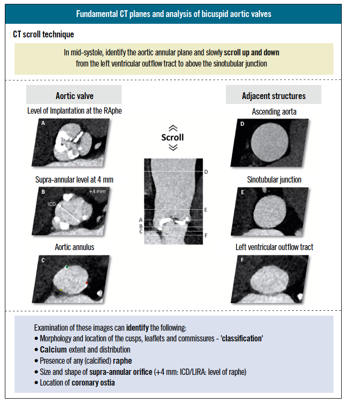 EuroIntervention tweet media